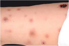 severe bacterial skin infections