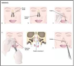 septoplasty procedure recovery