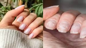 allergic reaction woman s nails