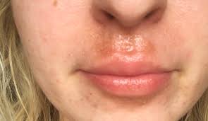 lip rash cheilitis eczema