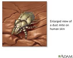 dust mite allergy