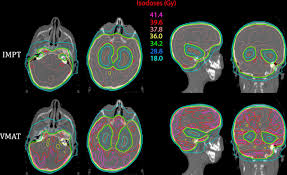 whole brain radiation therapy