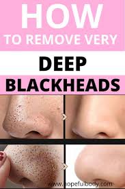However, whiteheads on the nose keep coming back; Pin On Beauty Hacks