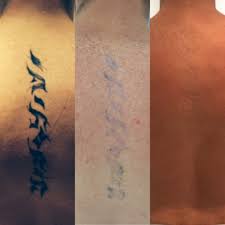 Larger tattoos will sometimes need up to 10 sessions to remove the tattoo entirely. Laser Tattoo Removal Ink Illusions