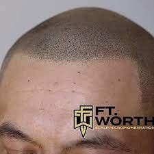 fort worth scalp micropigmentation 20