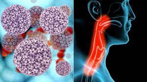 Clifford g., franceschi s., diaz m., mucoz n., villa l. 5 Things To Know About Hpv Related Throat Cancer Everyday Health