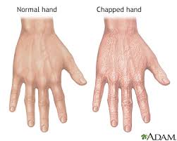 chapped hands information mount sinai