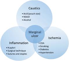 risk factors for marginal ulcer