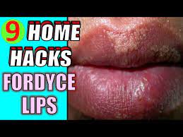 home remes for fordyce spots on lips
