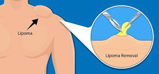 lipoma removal in singapore dr aaron