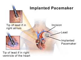 Does it give you shocks? Difference Between A Pacemaker And An Icd Difference Guru