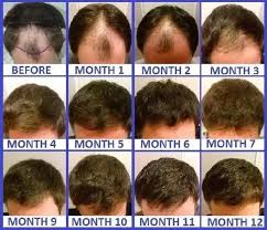 So it's not clear how long the virus may be able to survive on that growing and increasingly unruly mound. How Does Hair Grow Quora