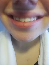 Just ask him/her what your braces are doing exactly. Flared Teeth After Braces How Can I Fix This Very Unhappy With The Result Photos