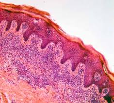 раннее начало грибовидного микоза. Случай из практики Early onset of mycosis  fung