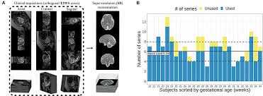Fetal Brain Biometric Measurements