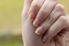 common nail abnormalities