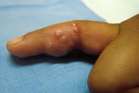 herpetic whitlow whitlow finger nhs