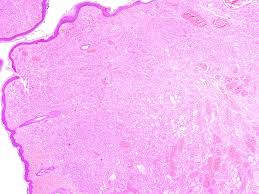 pathology outlines hemangioma variants