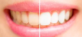 You can also steep your tea for a little less time to lighten it up a bit. Tea And Coffee Teeth Stains How To Remove Them Dentist In Arkansas City Kansas