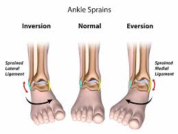 ankle sprain treatment symptoms and