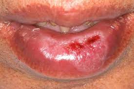 actinic cheilitis or discoid lupus