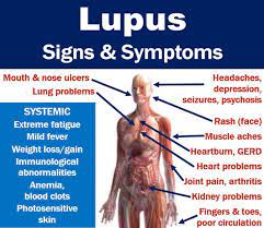 lupus signs and symptoms with full
