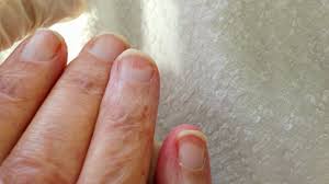 After getting acrylics, edwards says some people may experience a tightening sensation due to the acrylic forming a firm seal over your nails. Terry S Nails Pictures Causes Treatment Vs Lindsay S Nails