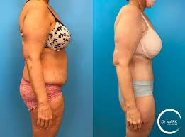 4 tummy tuck before after photos that