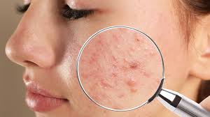 14 causes of acne flare ups you might