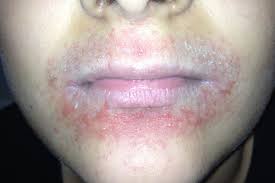 clinical challenge rash around mouth