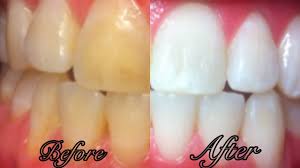 Repeat the same process for twice a day till you cleared the infection completely from your body. How To Whiten Your Teeth At Home Nearby Dental