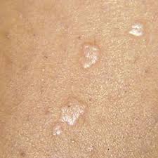 how to distinguish flat warts from