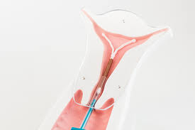 Check spelling or type a new query. Iud Intrauterine Device Obstetrics Gynecology Of Atlanta