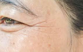 puffy eyes causes and treatments for