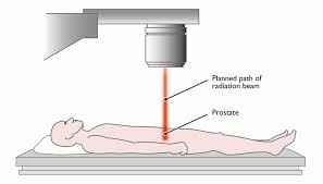 The entire prostate gland is radiated when we treat the cancer. Orchid Radiotherapy