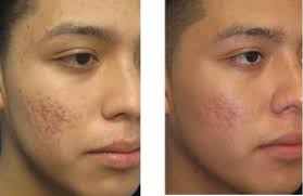 Image result for Laser Acne Scars Removal