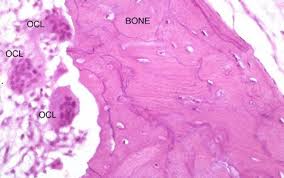 Paget disease with dermal invasion occurs when paget cells cross the basement membrane of the epidermis; Paget S Disease Pathology Orthobullets