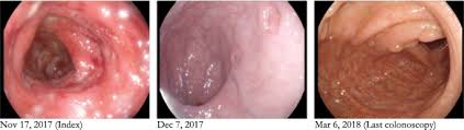 Can result in tears that ooze blood, erosion, or ulcers. Crohn S Like Disease In A Patient Exposed To Anti Interleukin 17 Blockade Ixekizumab For The Treatment Of Chronic Plaque Psoriasis A Case Report Bmc Gastroenterology Full Text