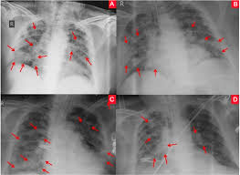 The Role Of Chest X Ray In Monitoring