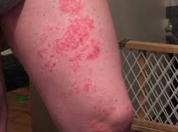 treating shingles on your leg and groin