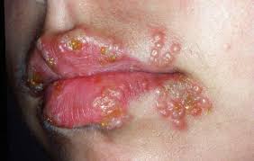 cold sore on lip causes prevention