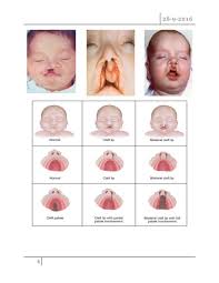 cleft lip and cleft palate pdf د