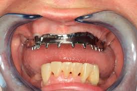 zubní implant cena ostrava po