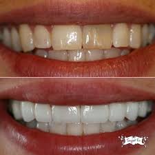 Details about instant smile teeth bottom veneers fake cosmetic dr bailey s dental makeover new. Building Back Your Bite Porcelain Veneers Sugar Fix Dental Loft
