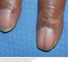 pigmented nail disorders basiccal key