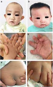 chinese children with kabuki syndrome