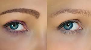 removal of permanent make up by the doctor