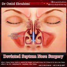 deviated septum nose surgery nose
