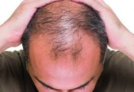 hair loss due to steroids causes