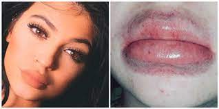 bruised lips are the new trend
